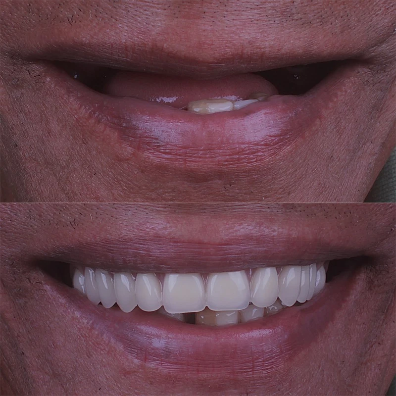 Resultado Implantes Dentários