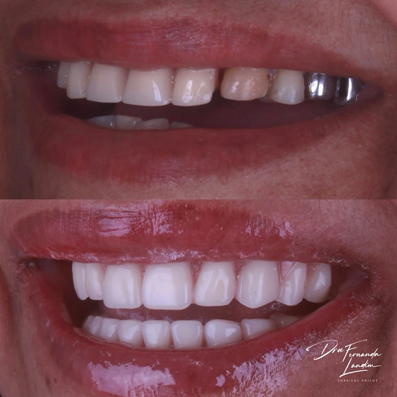 Resultado Implantes Dentários