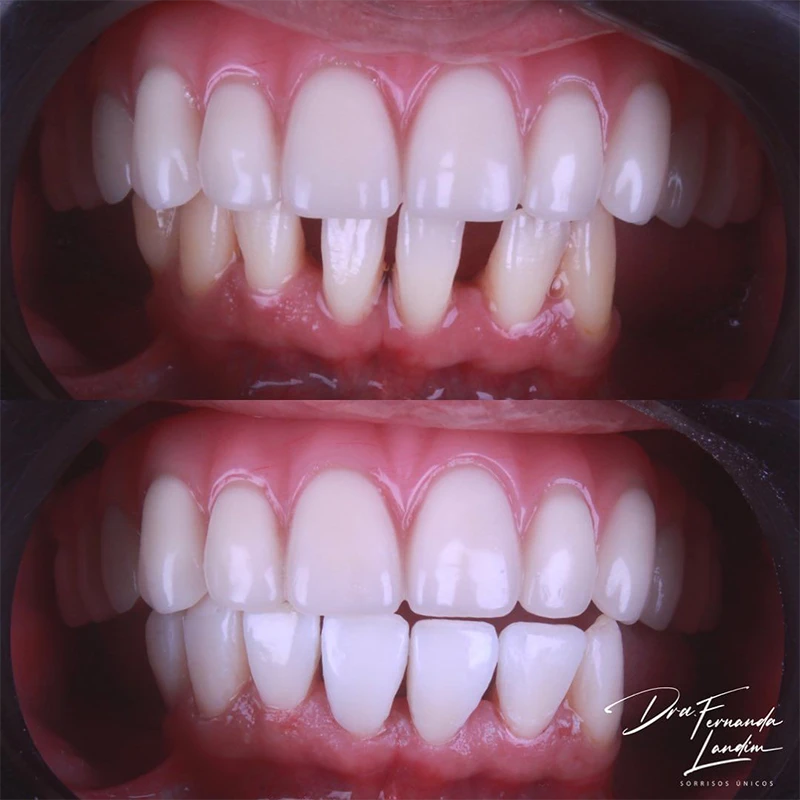Resultado Implantes Dentários