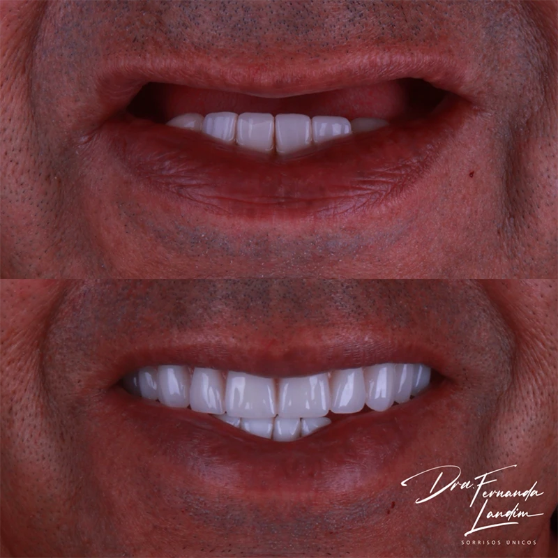 Resultado Implantes Dentários
