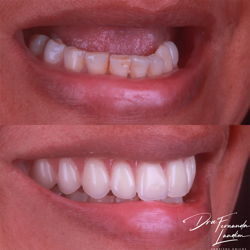 Resultado Implantes Dentários