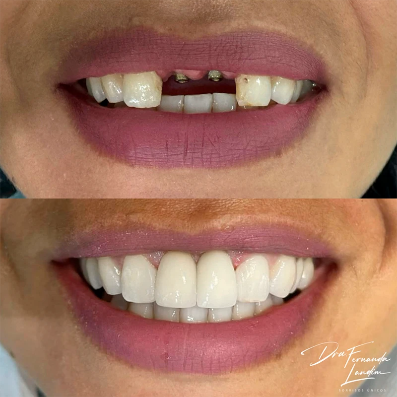 Resultado Implantes Dentários