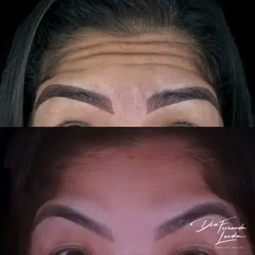 Depoimento Botox Estético