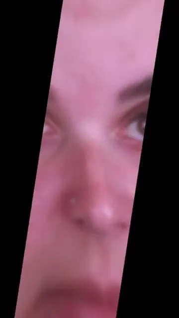 Depoimento Botox Estético