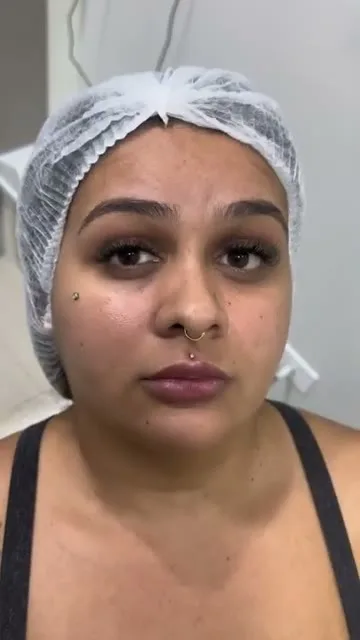 Depoimento Botox Estético