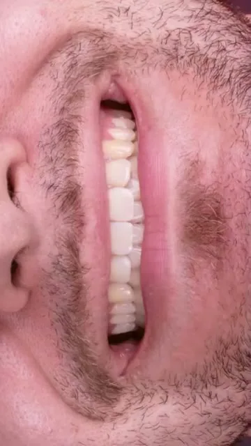 Depoimento Facetas em Resina