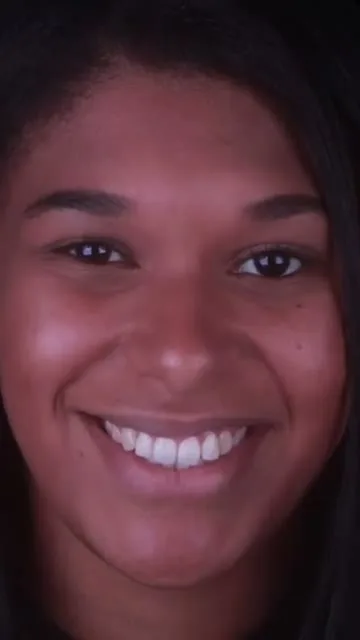 Depoimento Facetas em Resina