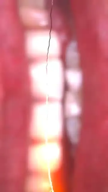 Depoimento Implantes Dentários