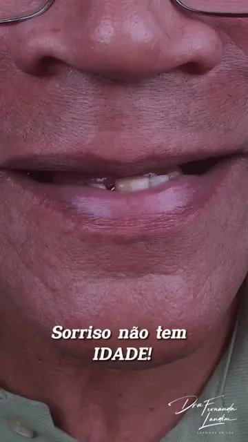 Depoimento Implantes Dentários