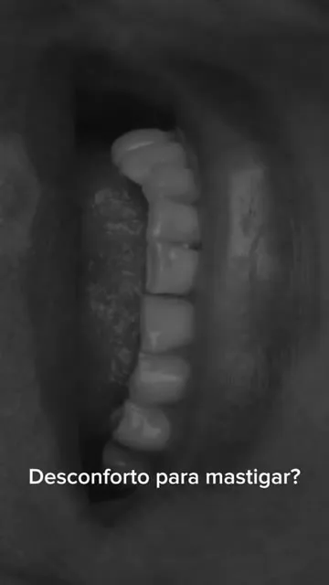 Depoimento Implantes Dentários