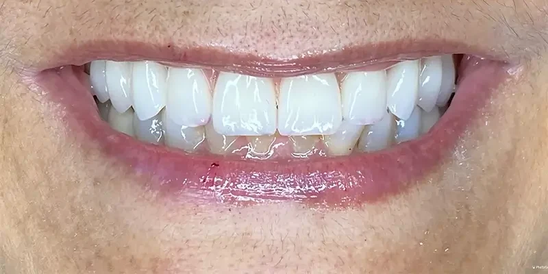 Resultado de 2, depois do tratamento