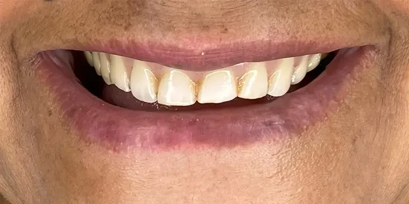 Resultado de 3, antes do tratamento