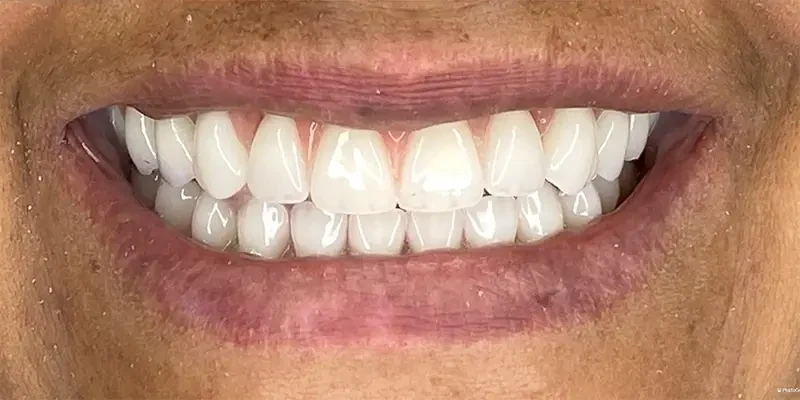 Resultado de 3, depois do tratamento