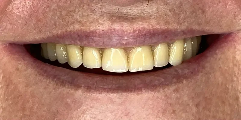 Resultado de 4, antes do tratamento