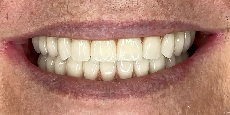 Resultado de 4, depois do tratamento