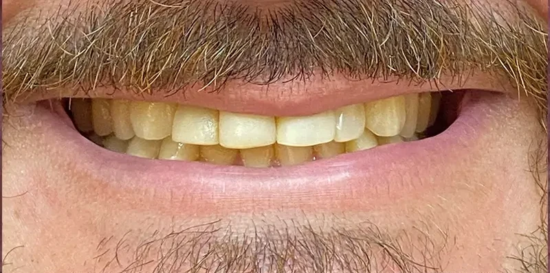 Resultado de lentes porcelana, antes do tratamento