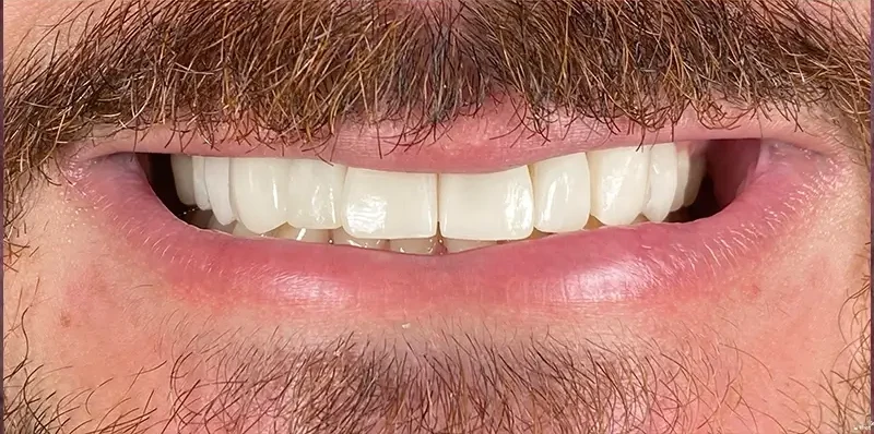 Resultado de lentes porcelana, depois do tratamento