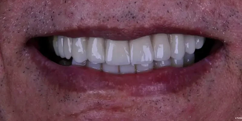 Resultado de lentes porcelana, depois do tratamento