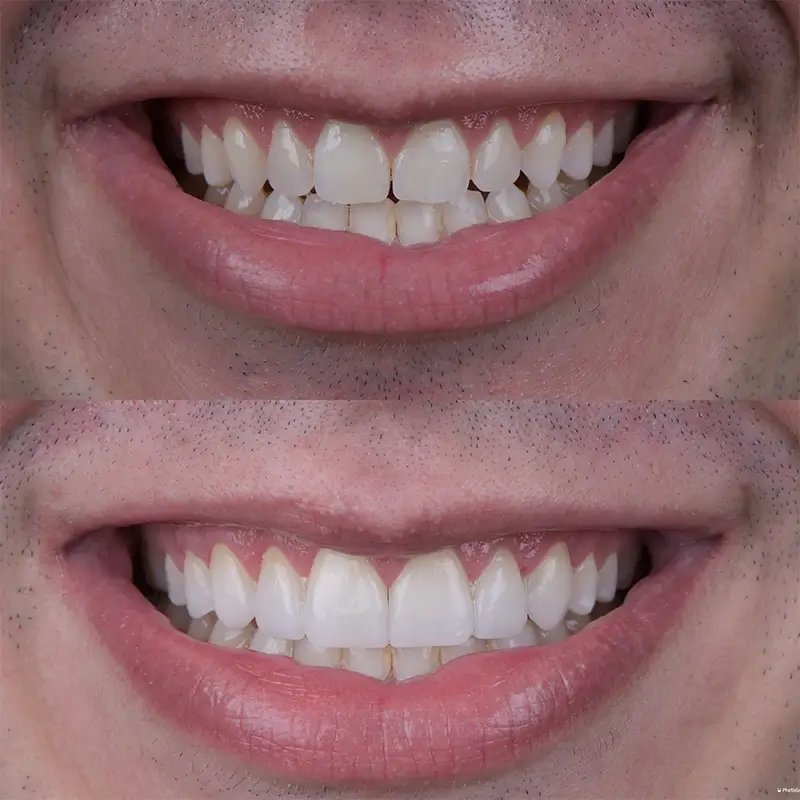 Facetas em Resina · Dra. Larissa Andreo
