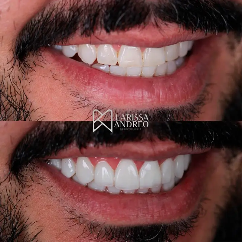 Caso real de facetas em resina 2