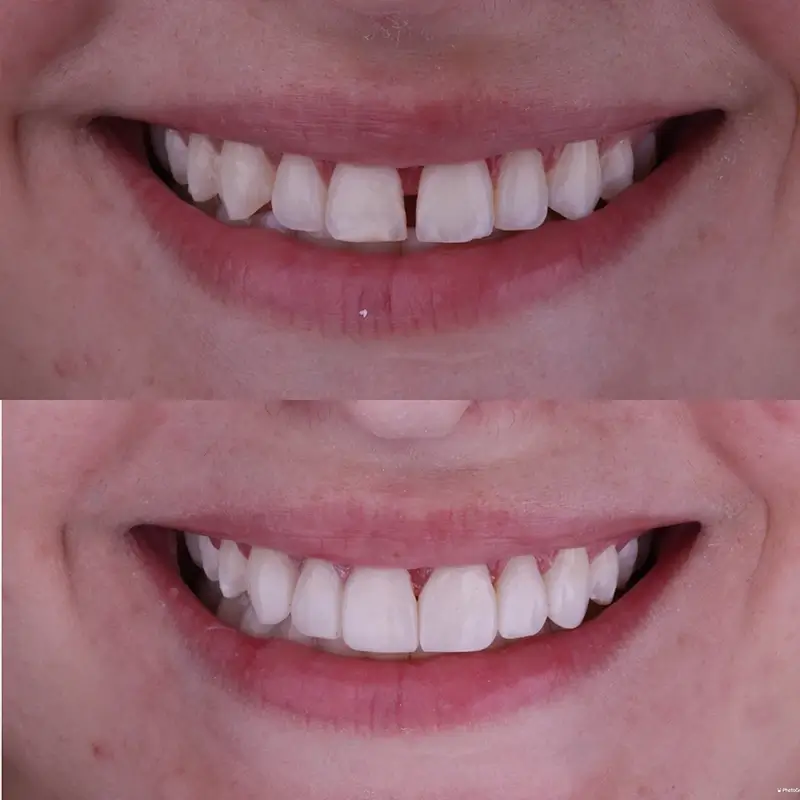 Caso real de facetas em resina 4
