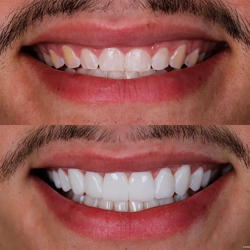 Caso real de facetas em resina 5