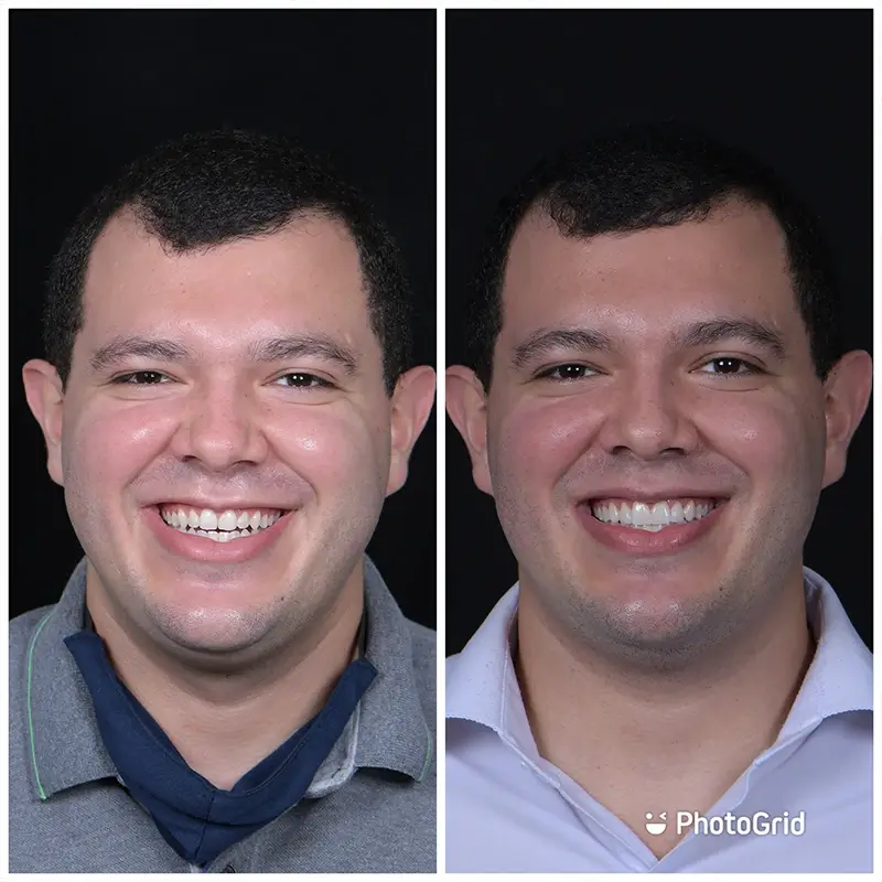 Caso real de lentes em porcelana 2
