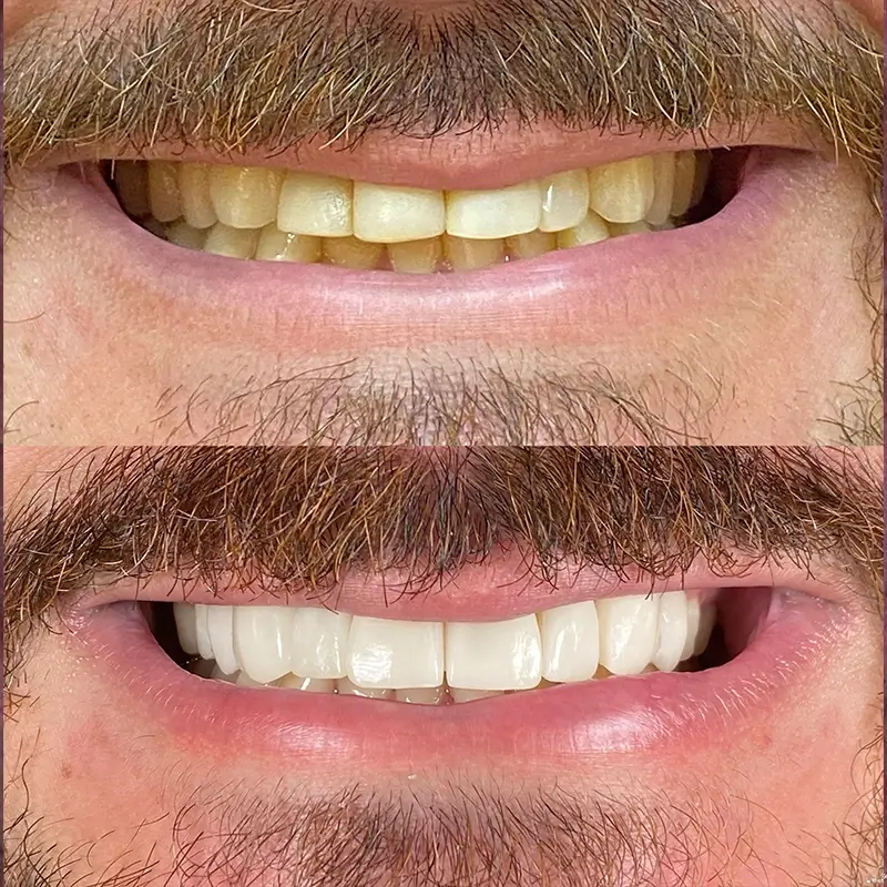 Caso real de lentes em porcelana 3