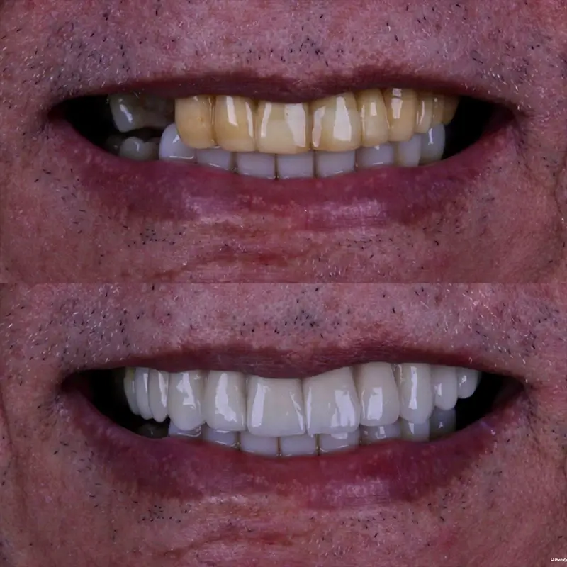 Caso real de lentes em porcelana 4
