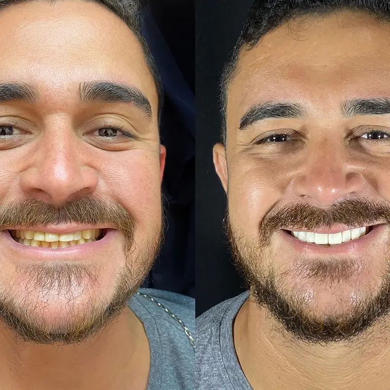 Caso real de lentes em porcelana 5