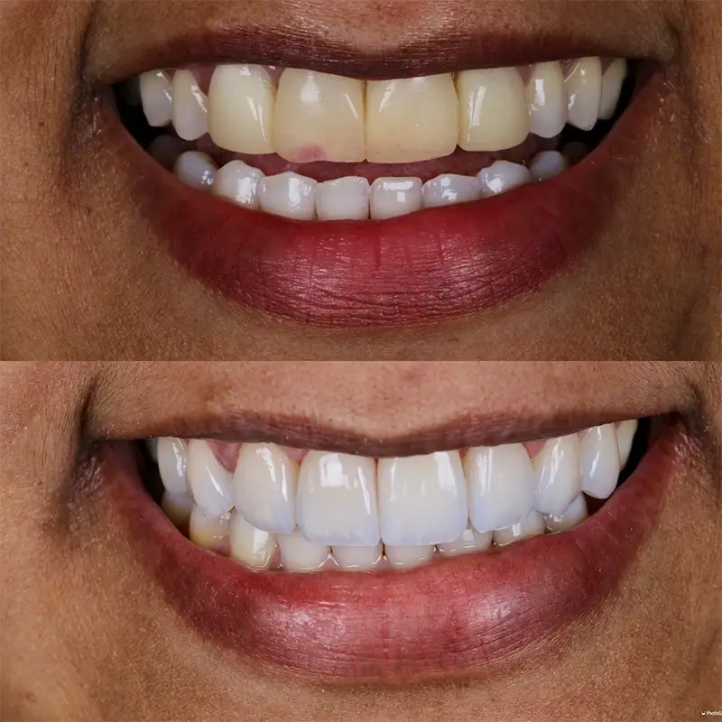 Caso real de lentes em porcelana 6