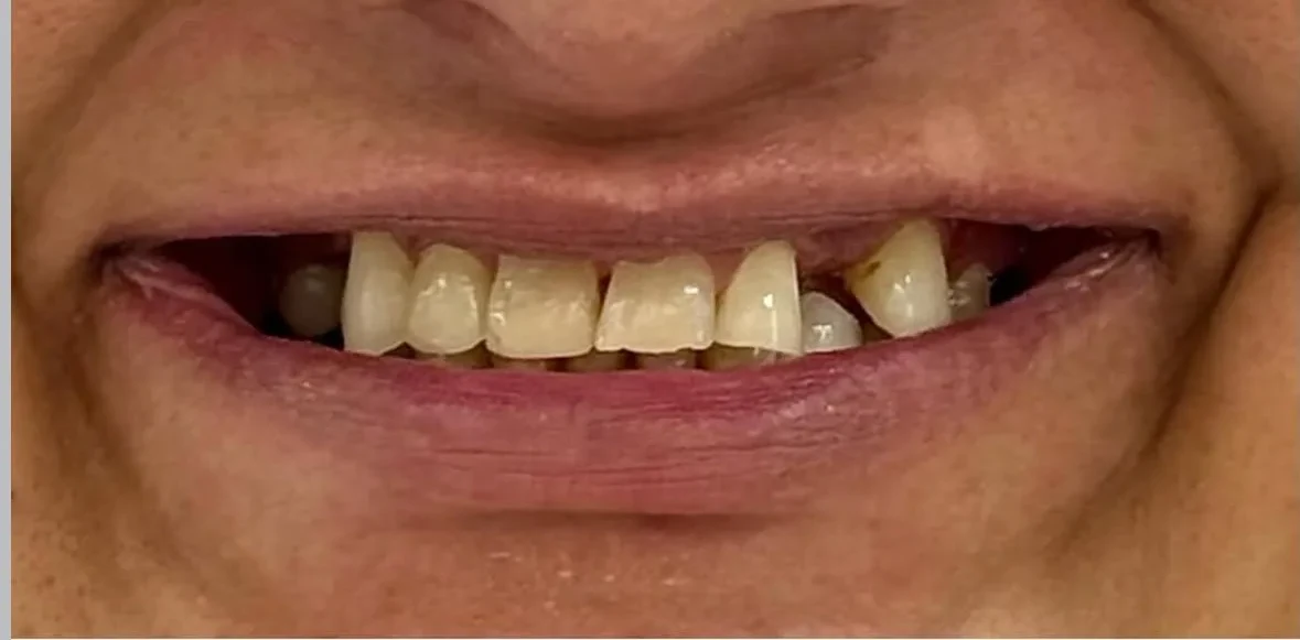 Resultado de facetas porcelana, antes do tratamento