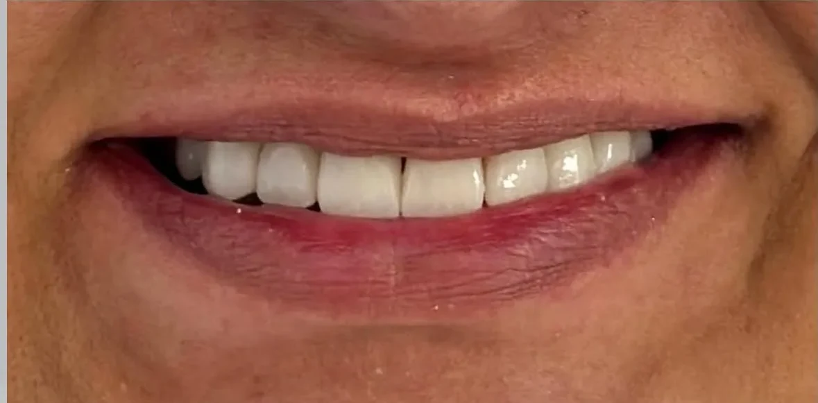 Resultado de facetas porcelana, depois do tratamento