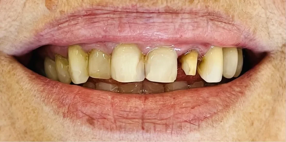 Resultado de facetas porcelana, antes do tratamento