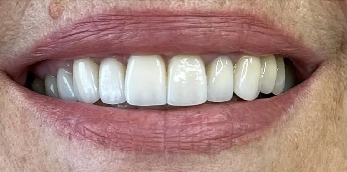 Resultado de facetas porcelana, depois do tratamento