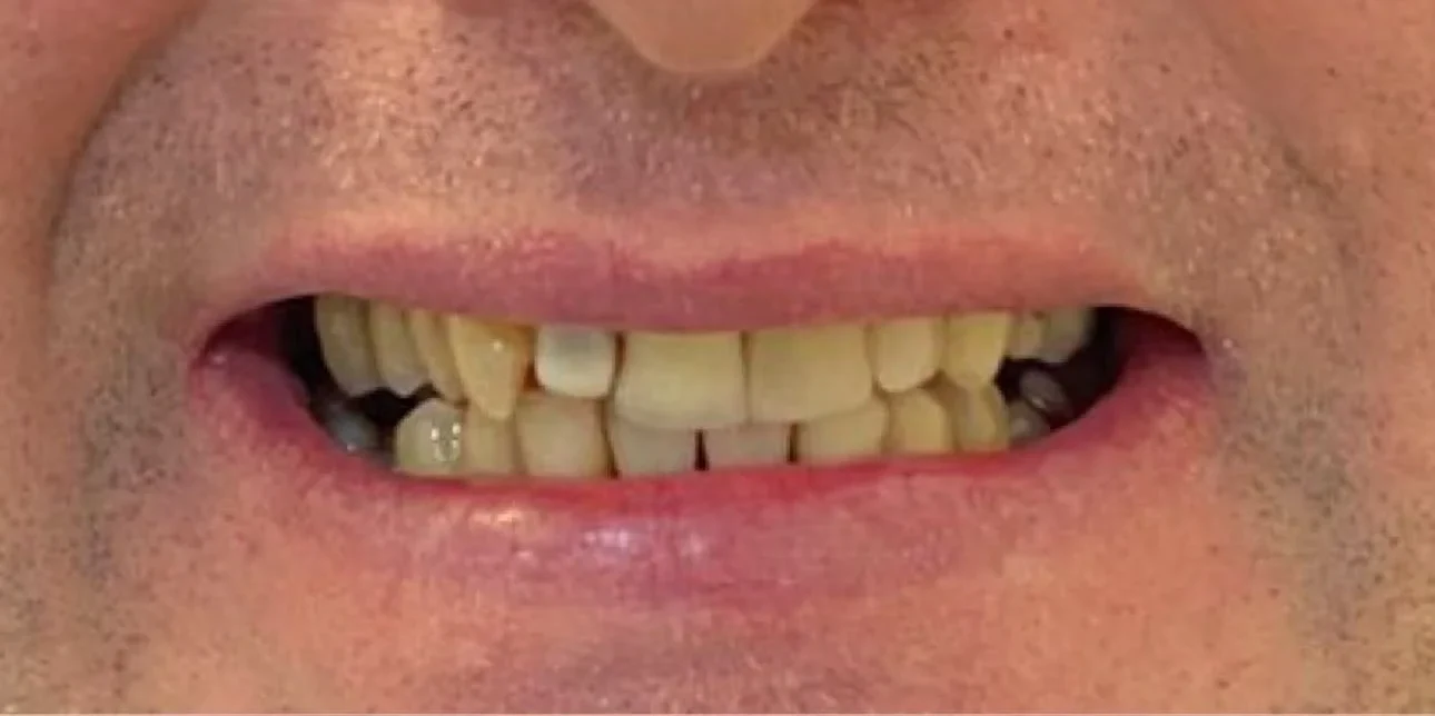 Resultado de implantes, antes do tratamento