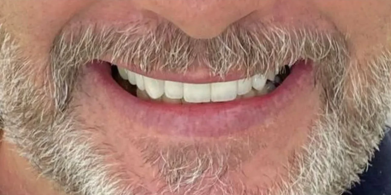 Resultado de implantes, depois do tratamento