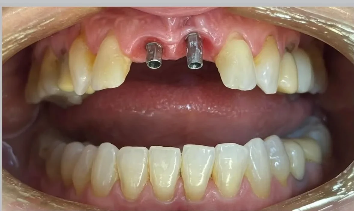 Resultado de implantes, antes do tratamento