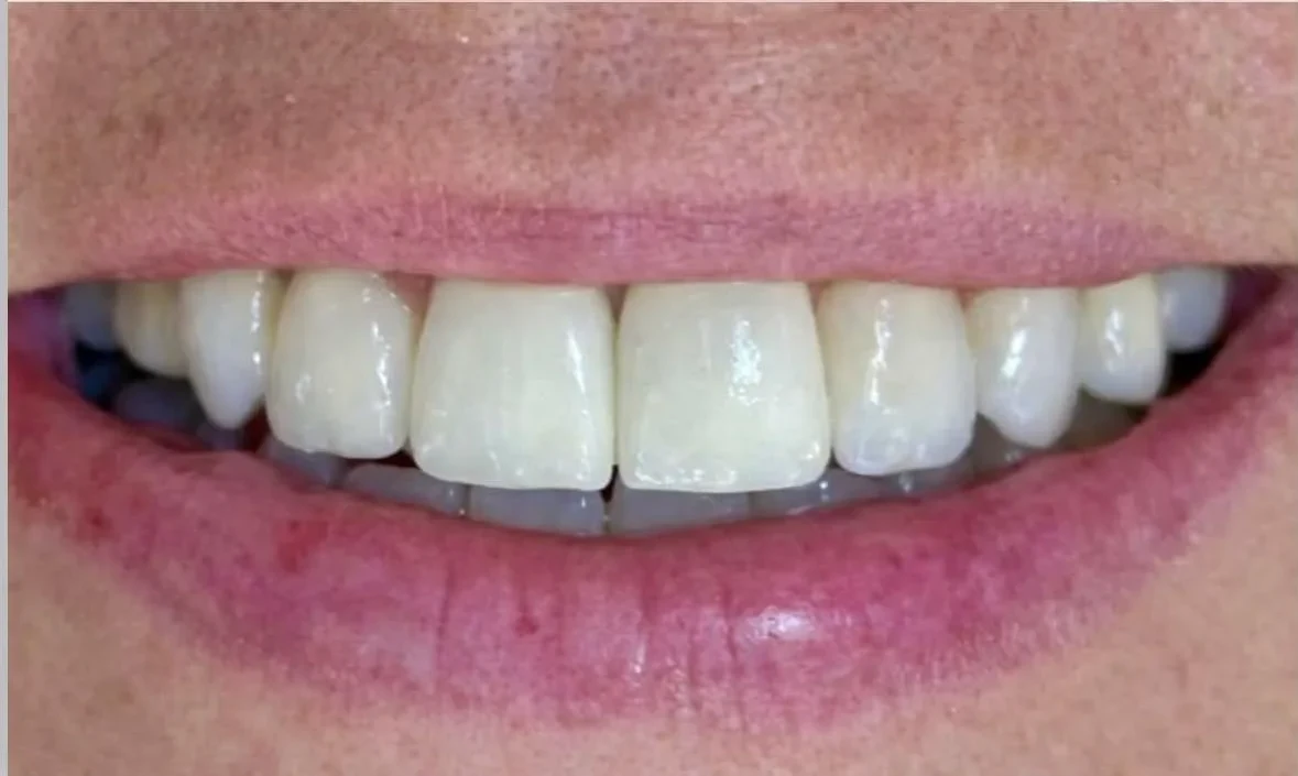 Resultado de implantes, depois do tratamento