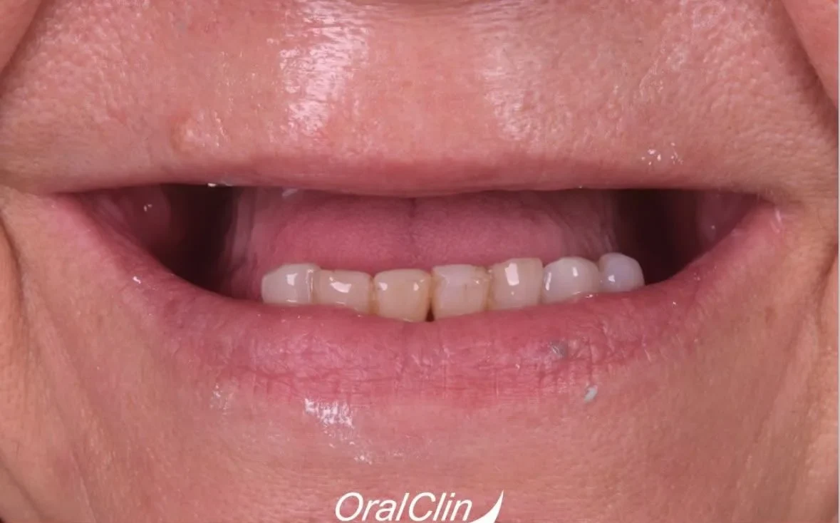 Resultado de implantes, antes do tratamento