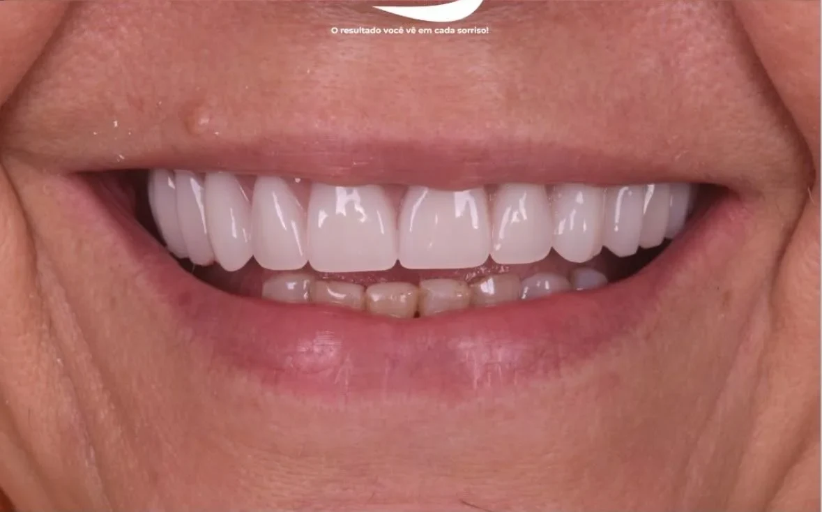 Resultado de implantes, depois do tratamento