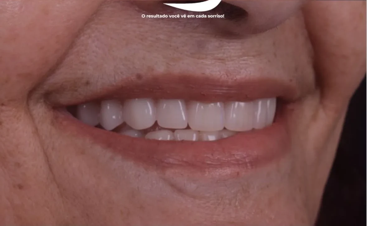 Resultado de implantes, depois do tratamento