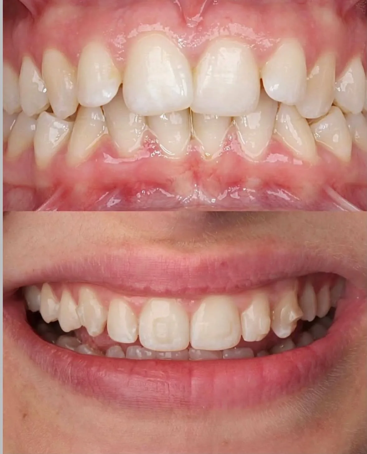 Alinhadores Invisíveis - antes e depois