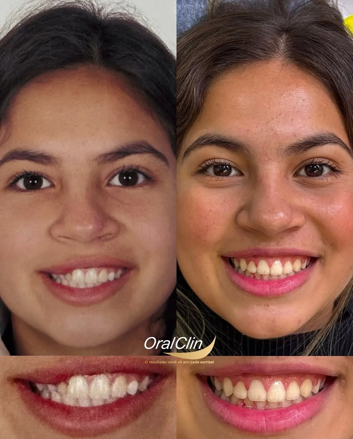 Ortodontia (Aparelho Fixo) - antes e depois