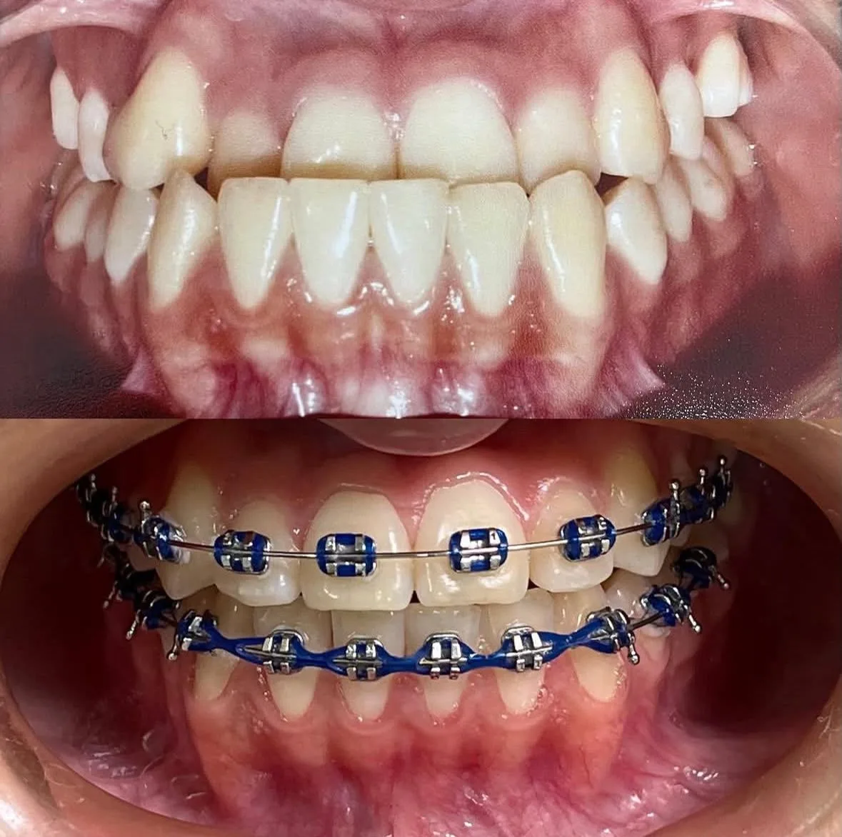 Ortodontia (Aparelho Fixo) - antes e depois