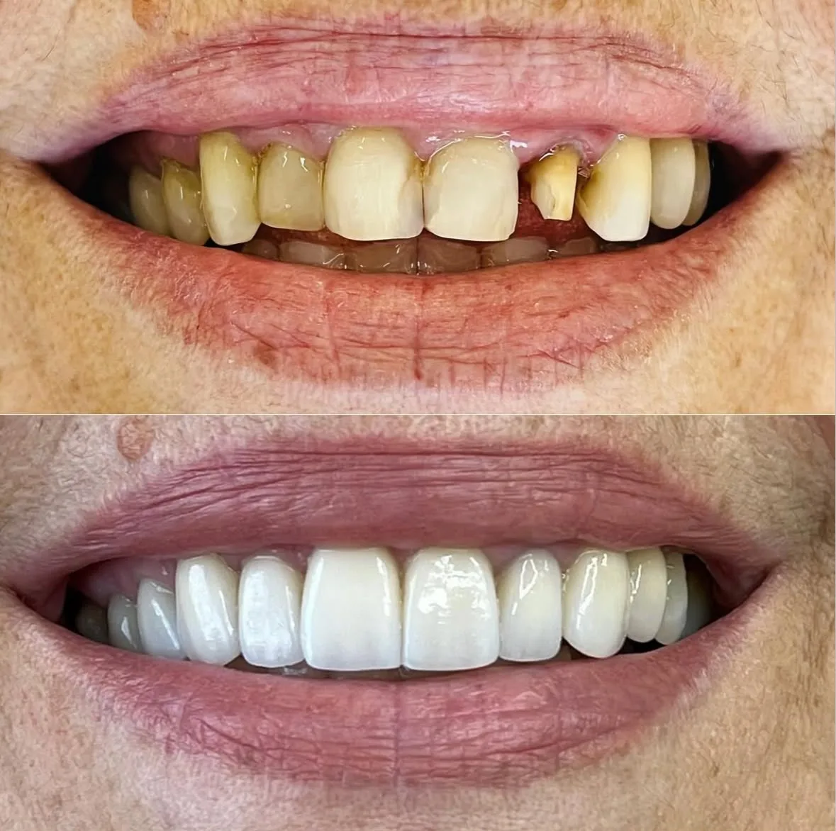 Facetas de Porcelana - antes e depois