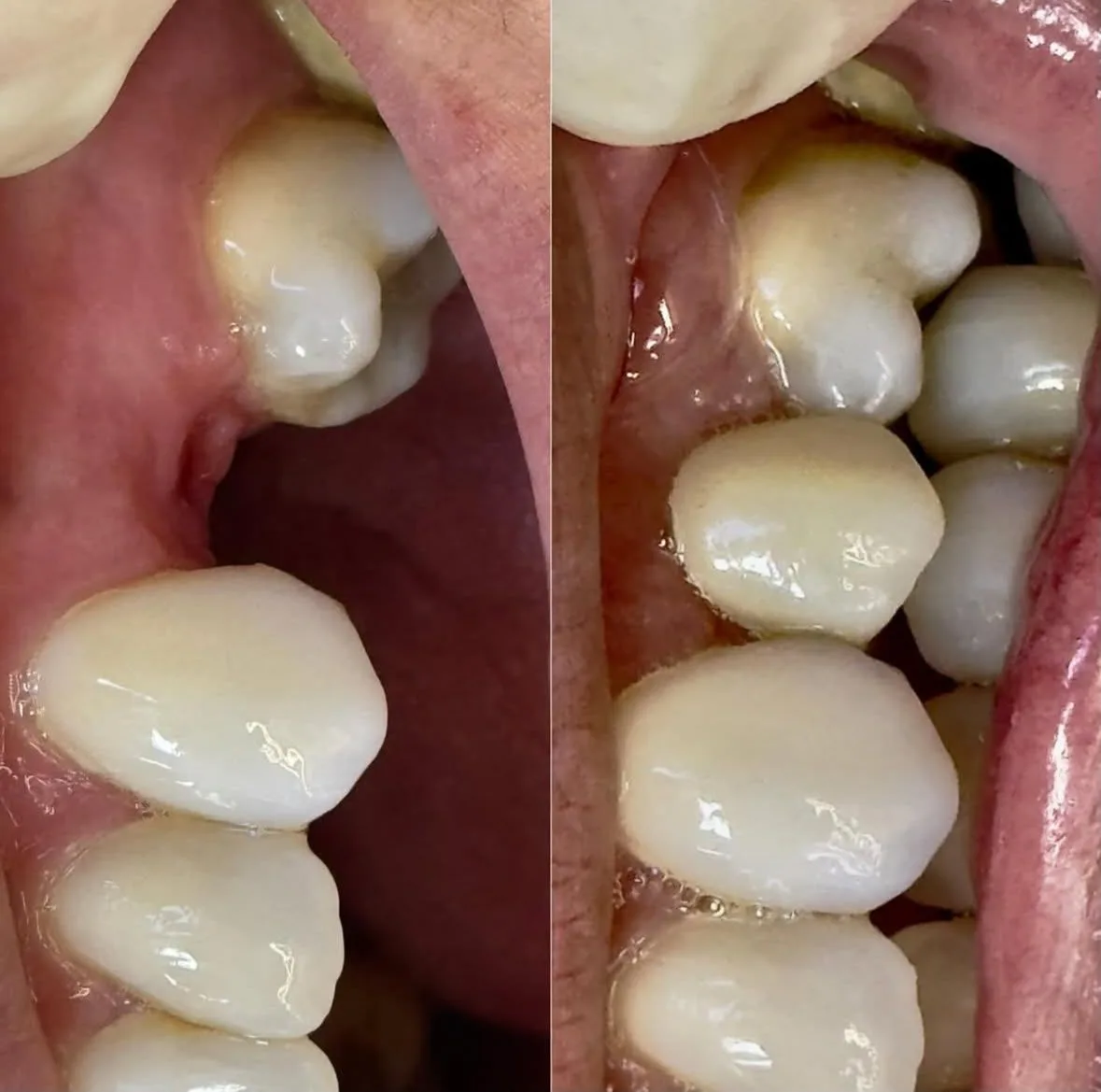 Implantes Dentários - antes e depois
