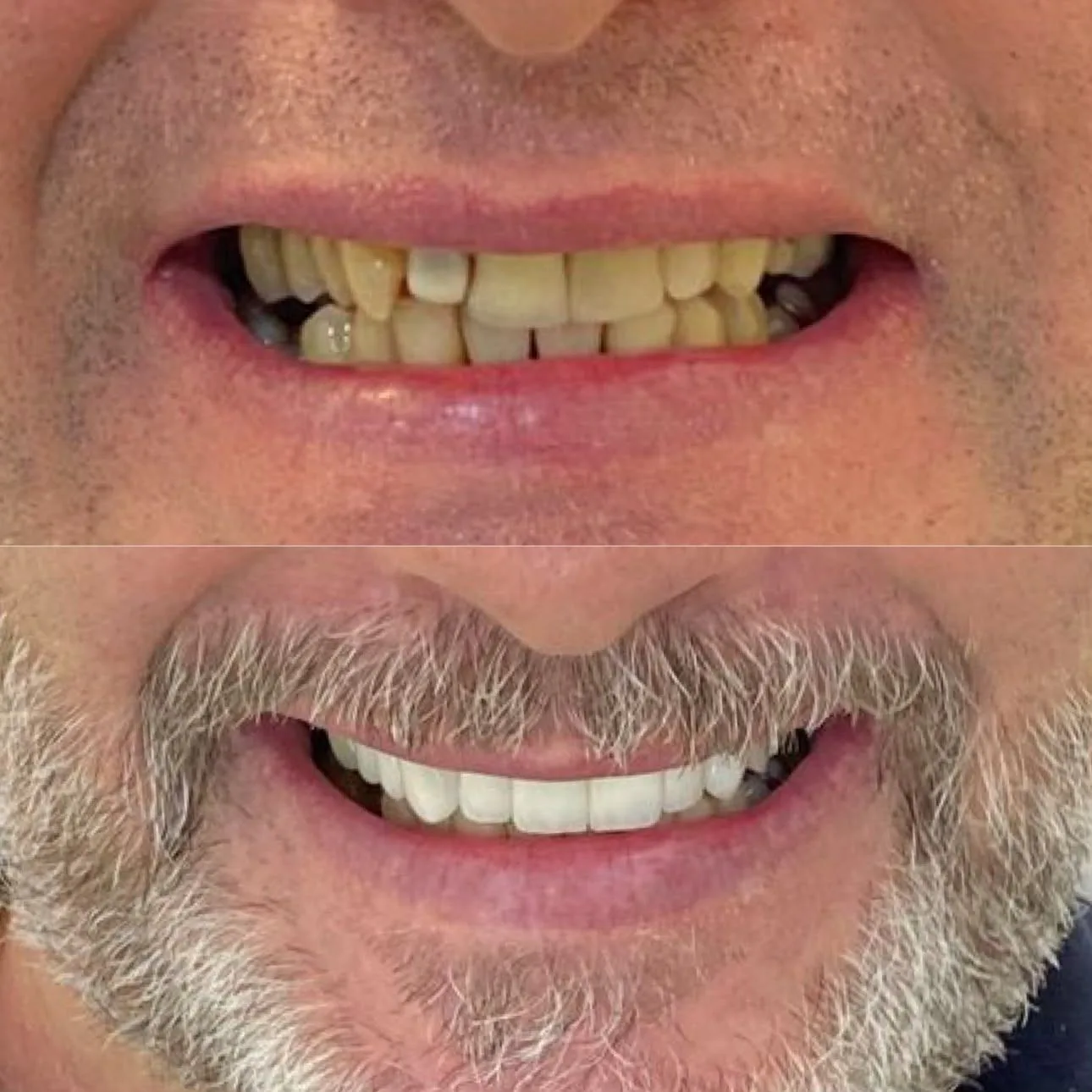 Implantes Dentários - antes e depois