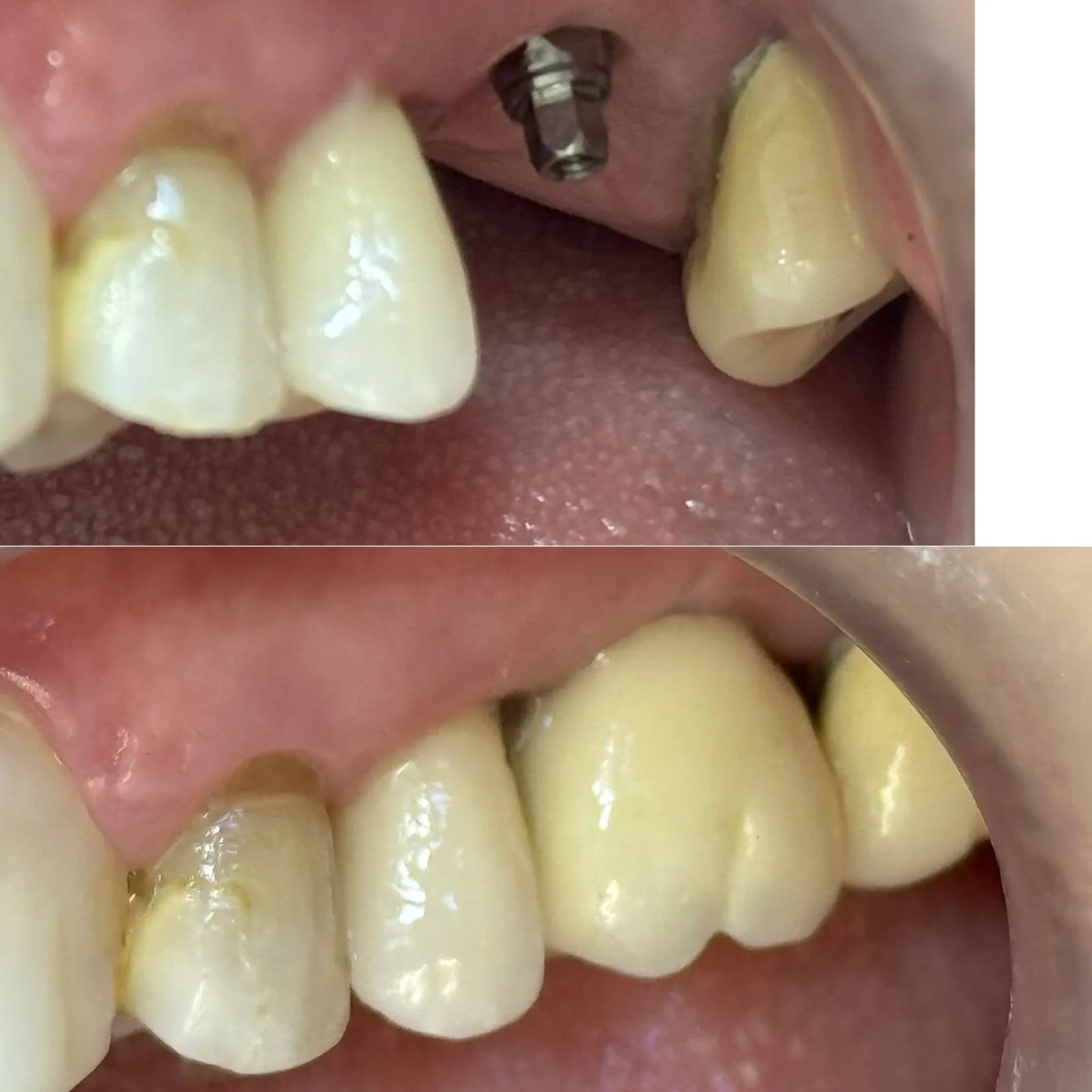 Implantes Dentários - antes e depois