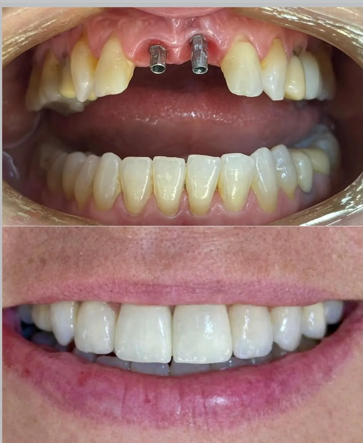 Implantes Dentários - antes e depois
